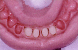 Fig 8: Insertion des dents prothétiques au niveau de l'empreinte