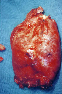 Fig. 5 b : Pièce opératoire : Après hémi-maxillectomie