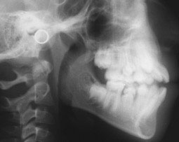 Fig.2 : Radiographies profile avant traitement 