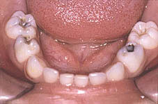 Fig. 2 : Vue endobuccale du maxillaire inférieur chez la même patiente