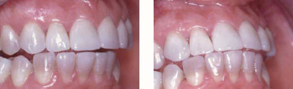 Fig. 17 et 18 : Cas de la figure 10. La répartition  des contacts en bout à bout sur plusieurs dents antérieures apporte une sécurité dans la pérennité des restaurations.