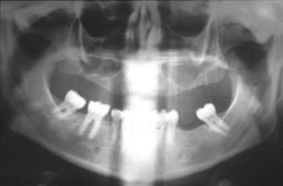 Fig 1 :  Radiographie panoramique dentaire mettant en évidence un apex dentaire intrasinusien responsable d’une réaction inflammatoire, visible sous la forme d’une opacité du bas fond sinusien. (Service O.R.L)