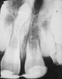 Fig 4 : Dent retenue, dent surnuméraire 