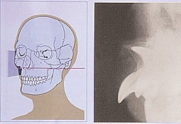Fig 8 : Mordu occlusal en incidence extra-buccale représentant une inclusion de la centrale maxillaire (Pasler). 