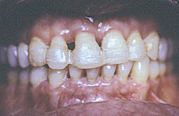 Fig. 2 :b- contention vestibulaire réalisée par le parodontiste