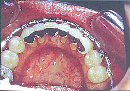 Fig.4c : contention définitive toujours réalisée avant la dépose de l'appareil orthodontique