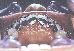 Fig. 6 :  contention définitive (attelle collée de canine à canine) réalisée avant la dépose de l'appareillage  orthodontique 