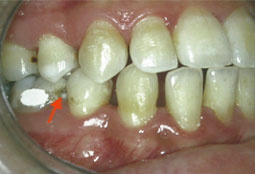 Fig. 10: Caries survenues sous une bague durant le traitement orthodontique, découvertes après dépose de l'appareillage