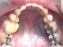 Fig 21 : Reprise de traitement orthodontique ;  problème de position mandibulaire de fin de traitement orthodontique. 