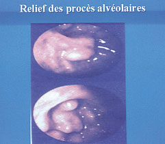 Fig. 1 : Rapport dents/sinus sur vue endoscopique du sinus maxillaire