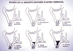 Fig.2 : Etapes de la sinusite dentaire d'après TERRACOL