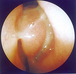 Fig.4 : Pus dans le méat moyen vu à l'examen rhinoscopique