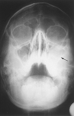Fig.5 : Opacité totale du sinus maxilaire droit