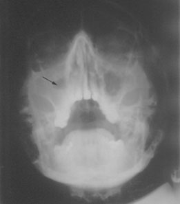 Fig.6 : Niveau hydro-aérique du sinus maxillaire Fig.6 : Niveau hydro-aérique du sinus maxillaire