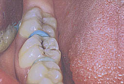 Fig.2 : Carie occlusale sur la 46 (Service odontologie conservatrice)