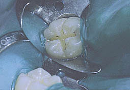 Fig.3 : Curetage de carie à minima sous champs opératoires (Service odontologie conservatrice)
