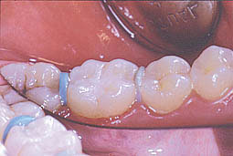 Fig.7 : Résultat après finition avec fraises à finir et disques (Service odontologie conservatrice)