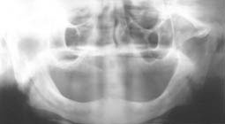 Fig.1 :  Aspect radiographique de la crête résorbée (C.C.T.D)