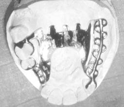 Fig.10 : La liaison rigide entre l’appui dento-parodontal et l’appui ostéo-muqueux dans les édentements terminaux n’est plus admise actuellement, car elle se comporte comme un taquet distal qui, à la longue entraînera la mobilisation de la dent concernée.