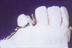 Fig.11b : Diastème secondaire à l’édentement. Pour des raisons esthétiques, le hiatus entre la 22 et la 23 doit être fermé au moyen d’une orthodontie mineure pour éviter la mise en place d’une dent prothétique en surnombre.