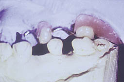 Fig.1e : Inocclusion entre 15 et 45.  Contact exagéré entre la tubérosité et la selle antagoniste.