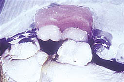 Fig.1f : Egression importante de 26 et réduction de l’espace disponible entre la crête édentée maxillaire et les dents antagonistes rendant impossible toute restauration prothétique maxillaire.