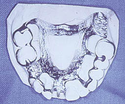 Fig.3b : Surcharge de la plaque qui ne remplace que trois dents. La rétention postérieure sur la 16 et la 17 est assez suffisante pour que l’appui cingulaire sur la 12 et la rétention sur la 13 soient éliminés.		    - La selle en arrière de 26 est également inutile car elle ne fait que créer un autre axe de rotation,				  - Par ailleurs, la barre coronaire pouvait être substituée par un simple appui indirect sur la fossette distale de 24.