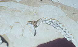 Fig.6a : Le crochet ne circonscrit pas suffisamment la dent, donc possibilité de  forces de torsion sur celle-ci.