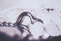 Fig.6b : Le crochet à jonction vestibulaire ne se justifie pas dans ce cas, puisque la hauteur de la gencive attachée est insuffisante.