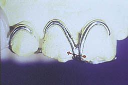 Fig.9d : Couronnes sur la 16 et 17. - Défaut de conception des crêtes marginales pour le franchissement occlusal du crochet  Bonwill, - Sur les faces vestibulaires, il n’a pas été prévu de bombés cervicaux pour la rétention du crochet Bonwill, ce qui explique sa situation proche de la gencive marginale.