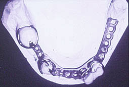 Fig.5a : Absence de taquet occlusal sur la fossette mésiale de 34 alors que la logette destinée à cet effet est déjà préparée.