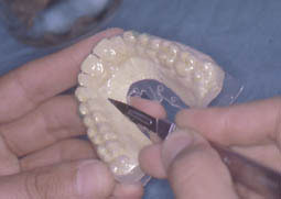 Fig. 5 . Découpage de la gouttière à 1 mm du bord ginguval pour éviter tout contact du produit avec la gencive