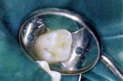 Fig.3a : Petite cavité occlusale sur la 65