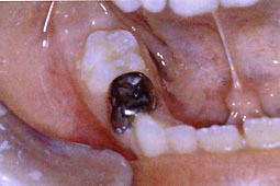 Fig.4a : Reconstitution de petites cavités occlusales sur la 85 au VIC (Kétac Silver*)