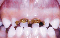 Fig.6a : Caries cervivales et proximales sur 52-51-61-62