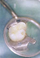 Fig.1b : Cavité proximale et palatine limitées à la carie