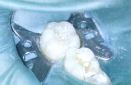 Fig.2a : Cavité classe II sur 85