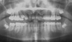 Fig.1 : Panoramique montrant la présence des canines maxillaires incluses et une rhizalyse au niveau  des incisives latérales.