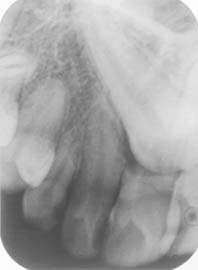 Fig. 14 : Rétro-alvéolaire montrant l’inclusion de la canine et la rhizalyse de la centrale