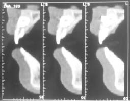 Fig. 17 : Coupe sagittale montrant le degré de rhizalyse de la centrale