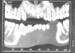 Fig. 19 : coupe panoramique curviligne montrant la position de la canine dans le sens vertical ainsi que le degré de rhizalyse de la centrale