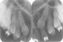 Fig.2 : Rétro-alvéolaire montrant la présence des canines maxillaires incluses et une rhizalyse au niveau  des incisives latérales.