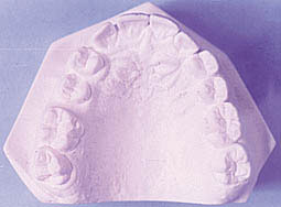 Fig. 3 : Moulage de l’arcade supérieure. Fig. 3 : Moulage de l’arcade supérieure.