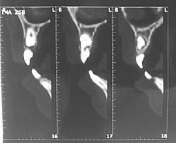 Fig. 4 : Coupes sagittales montrant le degré de rhizalyse de la 12 au niveau de la face distale, l’axe, puis la face mésiale de la dent.