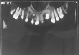 Fig. 8 : Coupes panoramiques curvilignes passant successivement par la racine palatine, la furcation et les racines vestibulaires des premières molaires supérieures, montrant la position des canines incluses dans le sens vertical et vestibulo-lingal