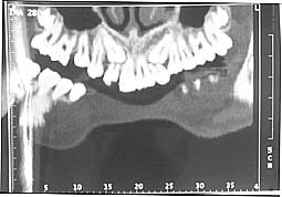 Fig. 7 : Coupes panoramiques curvilignes passant successivement par la racine palatine, la furcation et les racines vestibulaires des premières molaires supérieures, montrant la position des canines incluses dans le sens vertical et vestibulo-lingal