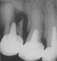 Fig. 10 : Image radio montrant une fracture latérale