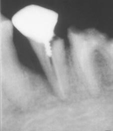 Fig. 6 : Image radio montrant une fracture avec une vis comme élément intra canalaire