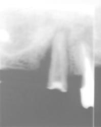 Fig. 3 : Image latérale sur une racine après dépose de la prothèse et de la RCR