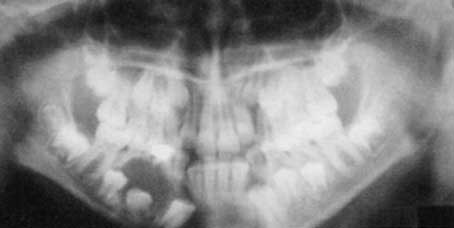 Fig. 4 : Radiographie panoramique montrant une image radio-claire, bien circonscrite, uniloculaire en rapport avec les racines de 84 et 85